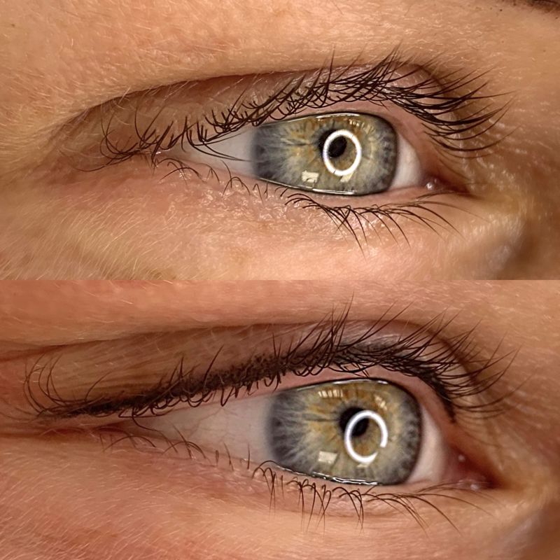 Wimpernkranzverdichtung