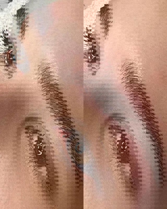 Augenbraunlifting 